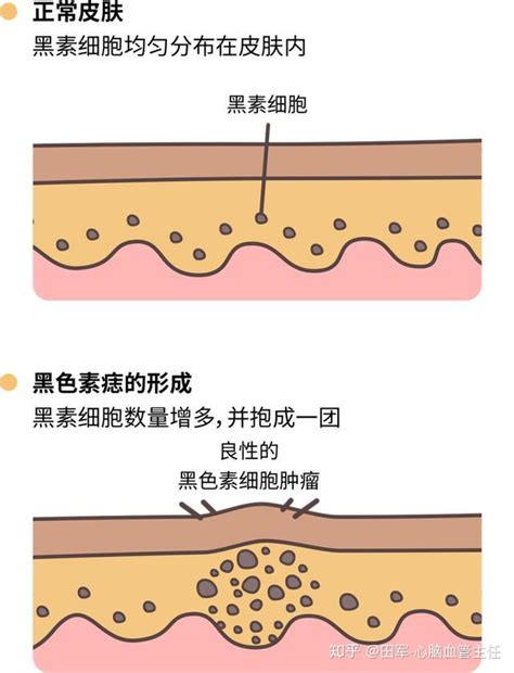 有問題的痣|痣也可能会癌变！长在 3 个地方要注意